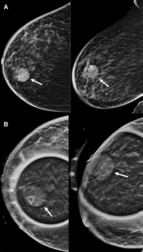 Mammogram of the right breast (A) with tomosynthesis spot compression... | Download Scientific ...