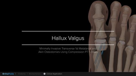 Hallux Valgus: Minimally Invasive Surgery Correction With Distal Transverse and Akin Osteotomies