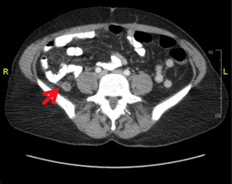 Cureus | Incidental Finding of Diverticulosis of the Appendix with ...