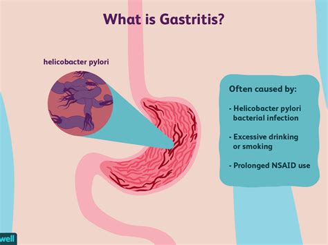 How To Reduce Gastritis - Signexercise2