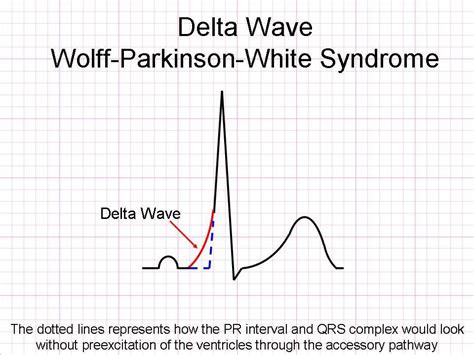 delta wave ecg - Google Search | Pr interval, Paramedic school, Waves