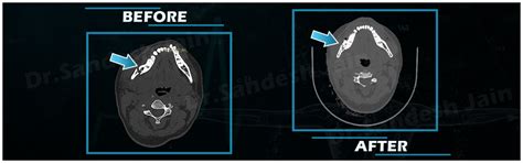 Our Cases - Jaw Correction Surgery