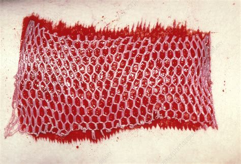 Mesh skin graft attached to burn injury - Stock Image - M336/0002 - Science Photo Library