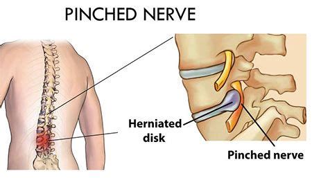 Pinched Nerve Treatment in NJ | Pain Management Doctor, Specialist