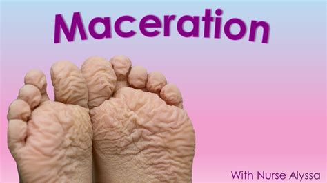 Understanding Wound Maceration - YouTube