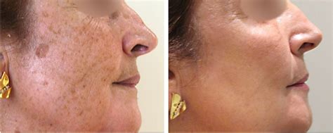 LASER FOR PIGMENTATION REMOVAL – Insight Derma Clinic