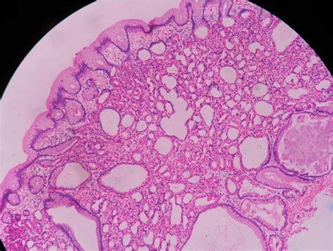 Fundic gland polyp – Histopathology.guru