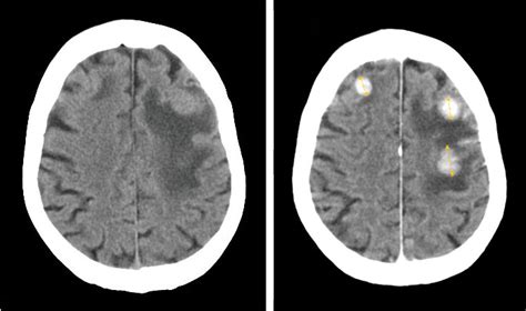 Iodinated contrast - Wikipedia