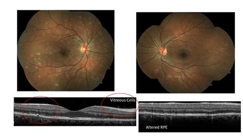 White Dot Syndromes Series Part 1: Multiple Evanescent White Dot Syndrome - Optometry Advisor