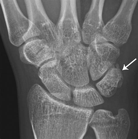 Multidetector CT of Carpal Injuries: Anatomy, Fractures, and Fracture-Dislocations | RadioGraphics