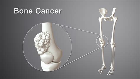 Bone Cancer: Types, Symptoms, Causes and Treatment - Scientific Animations