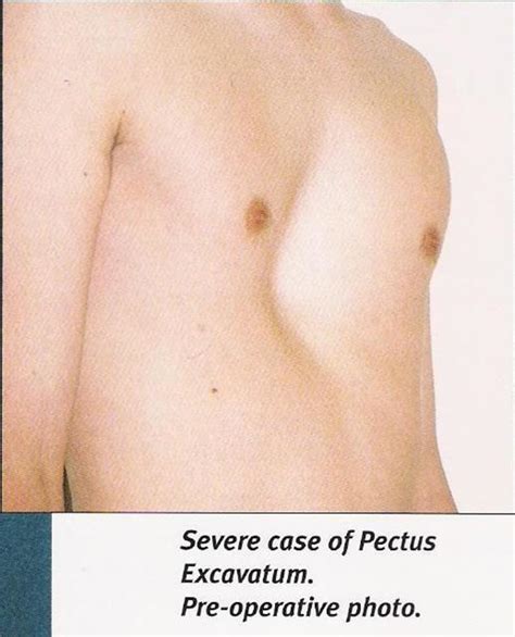 Pectus Excavatum Surgery Introduction - Surgery Options and Benefits ...