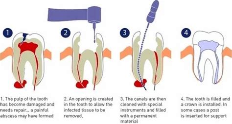 Root Canal Treatment in Vapi | ID: 6931067991