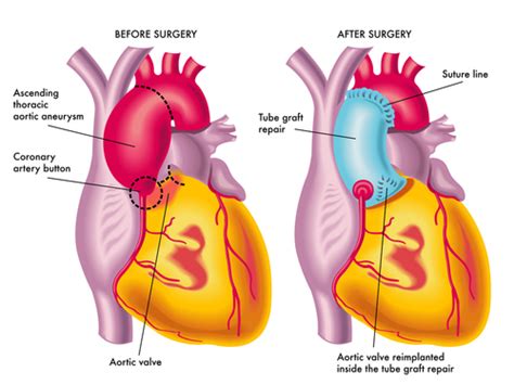 Ascending Aortic Aneurysm - Definition, Diagnosis, Treatment | LearntheHeart.com