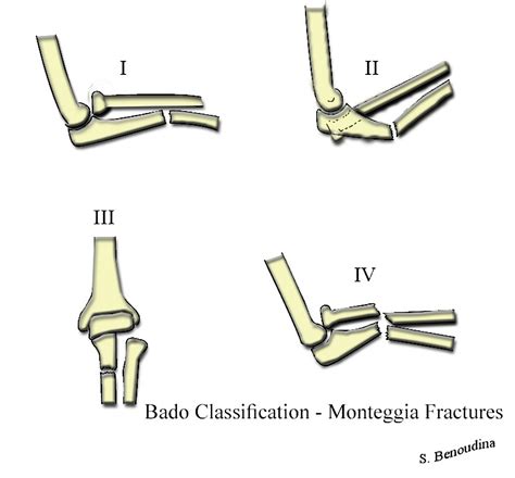 Bado Classification - wikidoc