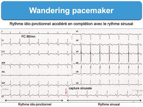 Wandering pacemaker : e-cardiogram