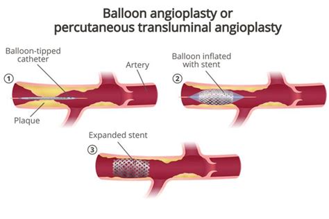 Percutaneous Transluminal Coronary Angioplasty (PTCA) | Parkway East ...