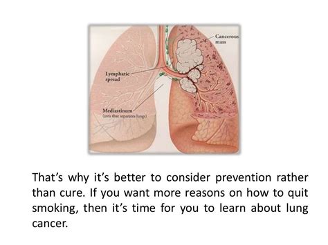 The Stages of Lung Cancer Caused by Smoking