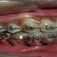 Intraoral placement of modified mandibular hyrax appliance. | Download ...