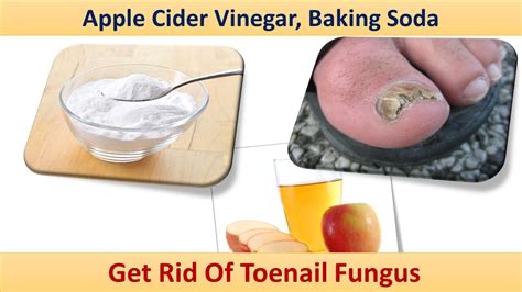 Apple Cider Vinegar And Baking Soda For Toenail Fungus / Toenail Fungus Treatment | Baking Soda ...