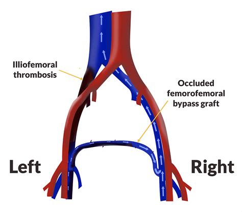 Occluded Femorofemoral Venous Bypass Graft | VDM