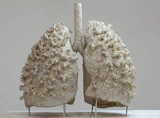 Bullous lung disease | General center | SteadyHealth.com