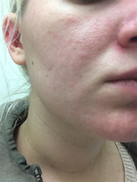 [routine help] always had red blotchy skin. Am i doomed to this or is there hope? Skincare ...