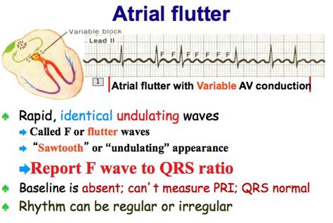 Atrial fibrillation vs flutter eeg - sekaprinter