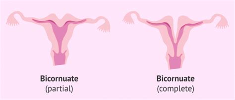 Types of bicornuate uterus