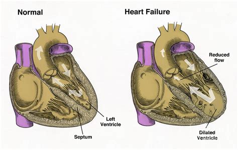 Healthy Heart Vs. Heart Failure Photograph by Spencer Sutton