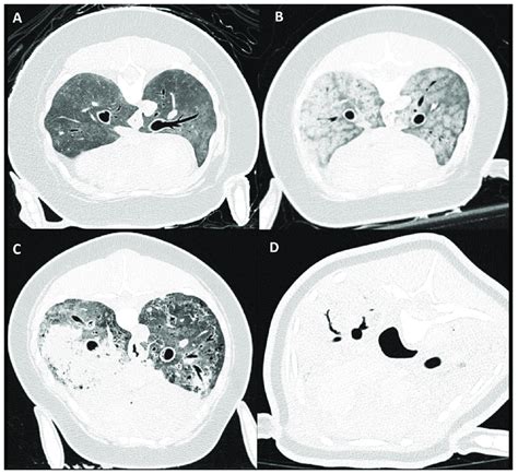 Pulmonary soft tissue attenuation score on PMCT. Clockwise presentation... | Download Scientific ...