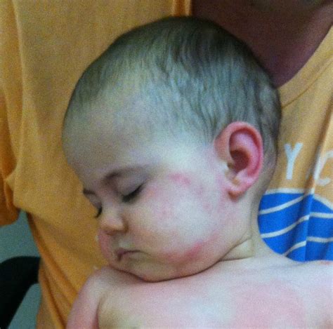 Baby Egg Allergy Rash Pictures - Get More Anythink's