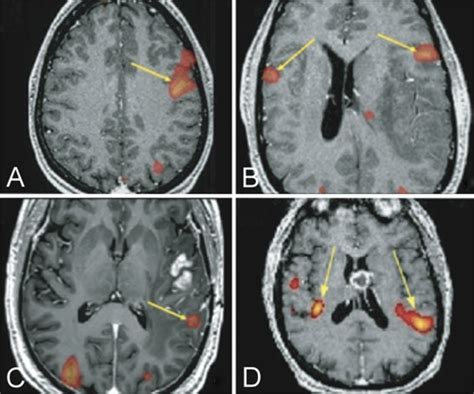 Representative fMR images A: Unilateral activation of Broca area... | Download Scientific Diagram