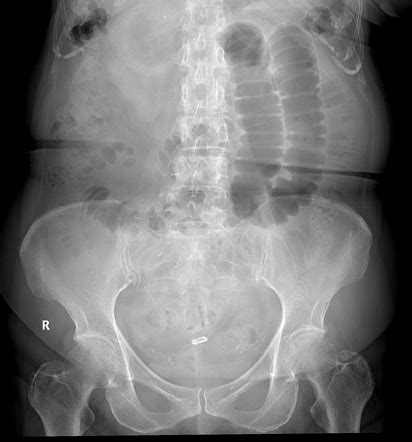 Gallstone ileus | Radiology Case | Radiopaedia.org