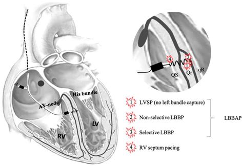 JCM | Free Full-Text | Comparing Ventricular Synchrony in Left Bundle Branch and Left ...