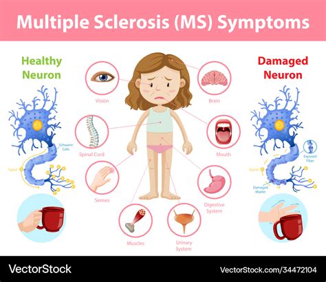 Multiple Sclerosis Autoimmune Diseases