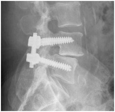 Lumbar Fusion X Ray