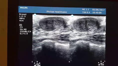 Fibroadenoma Sonography - YouTube