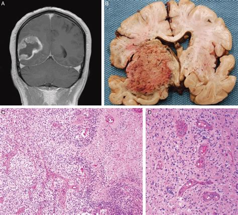 Glioma Diagnosis: Immunohistochemistry and Beyond : Advances in Anatomic Pathology