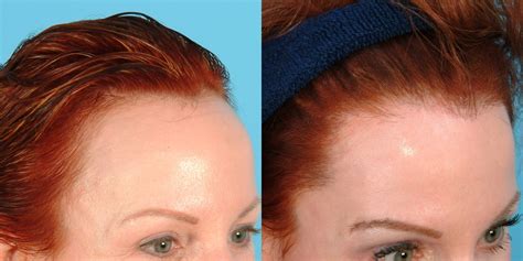 Female Hairline Lowering · Bauman Medical Group