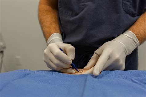 Mohs Surgery: The Most Effective Skin Cancer Treatment - Charleston Dermatology