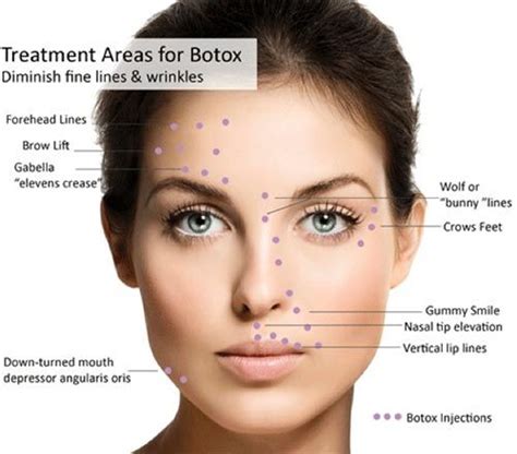 Botox Eyebrow Lift Injection Sites | Botox injection sites, Botox ...