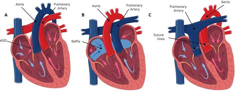 Management considerations in the adult with surgically modified d-transposition of the great ...