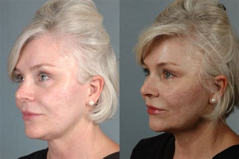 West Little Rock - Cosmetic Injectables & Fillers - Before and After Gallery