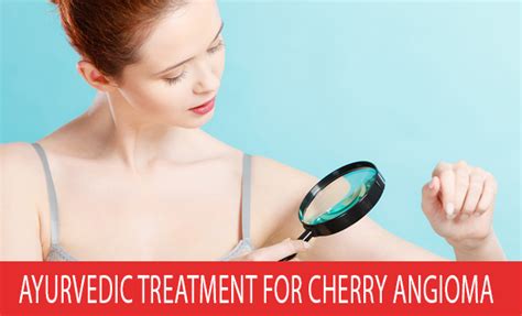 Ayurvedic Treatment for Cherry Angioma