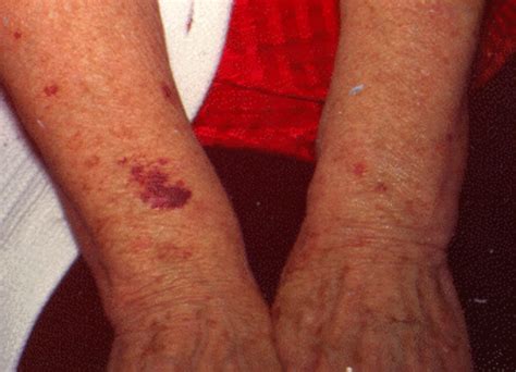 Causes of Senile Purpura - Information and Symptoms of Senile Bleeding ...