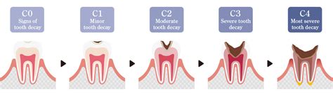 Churanami District cavity treatment rotting tooth resin to ceramic - 숲향기