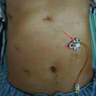 Condition of jejunostomy tube after 4 months from operation (the arrow... | Download Scientific ...