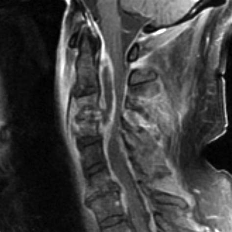 Epidural abscess MRI - wikidoc