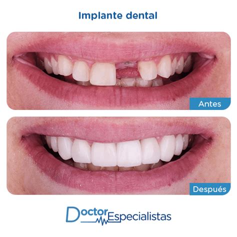 Mejores Clinicas En Implantes Dentales | Doctor Especialistas